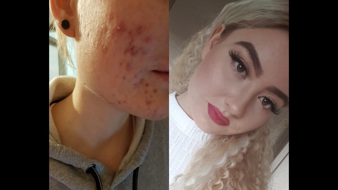 Akne Make-up für Anfänger  (Drogerie Produkten) //Chabedy//