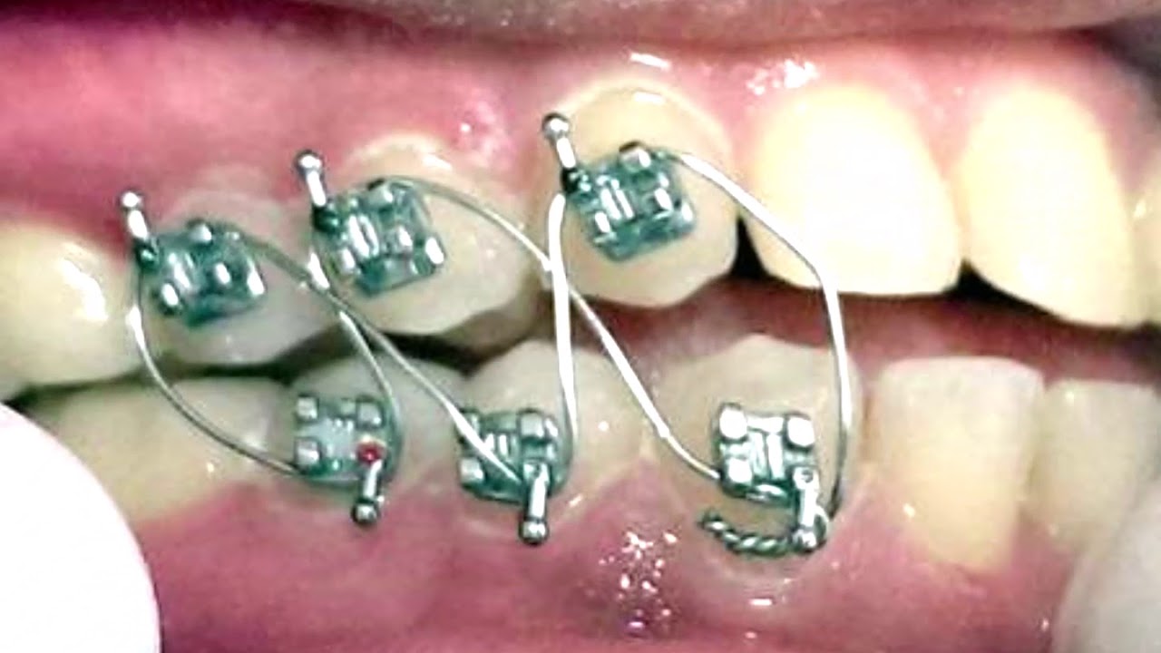 OJW™ Weight-Control Teaching the Patient to Wire Themselves with OJW Demo Tool