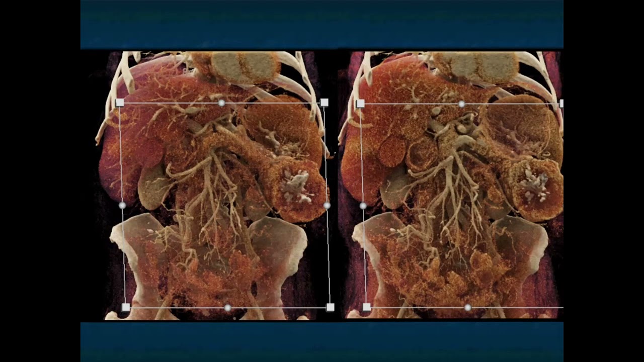 CT of Serous Cystadenomas of the Pancreas: A Lesion of Many Different Appearances - Part 3