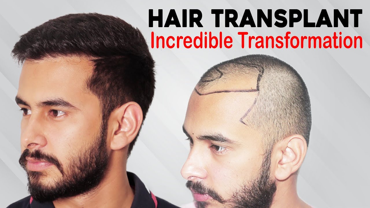 Best Hair Transplant in India Cost | Best Clinic | Medispa Hair Transplant in India | Dr Suneet Soni
