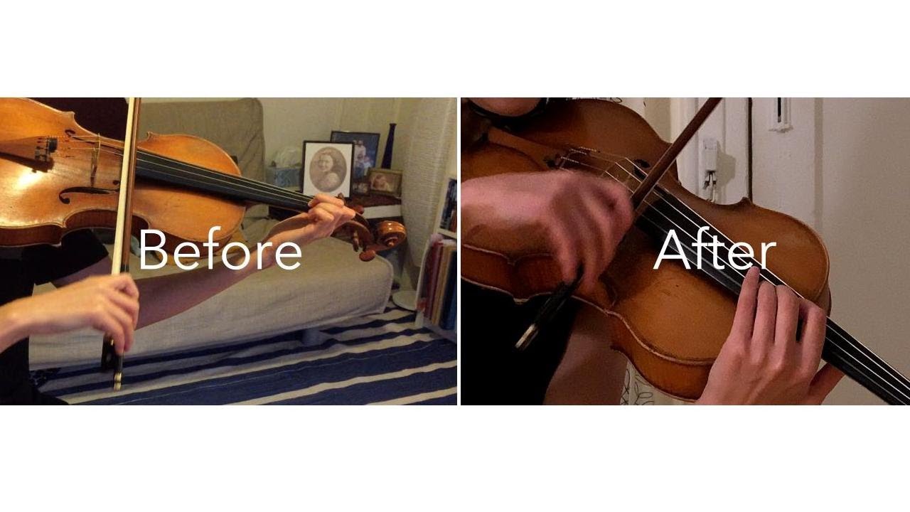 Musician's Focal Dystonia: Recovery IS POSSIBLE!