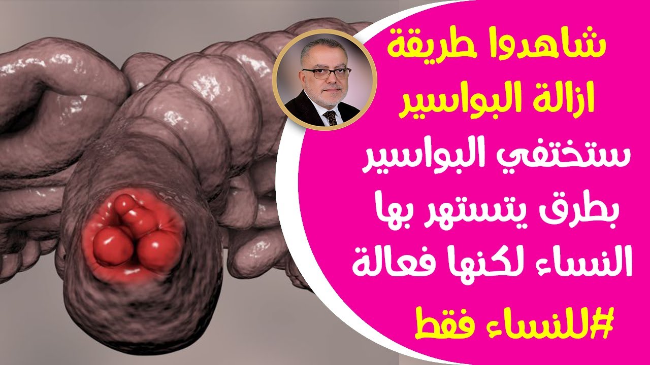 شاهدوا طريقة ازالة البواسيرللمرأة ستختفي البواسيربطرق تستهتربها السيدات لكنها فعالة في علاج البواسير