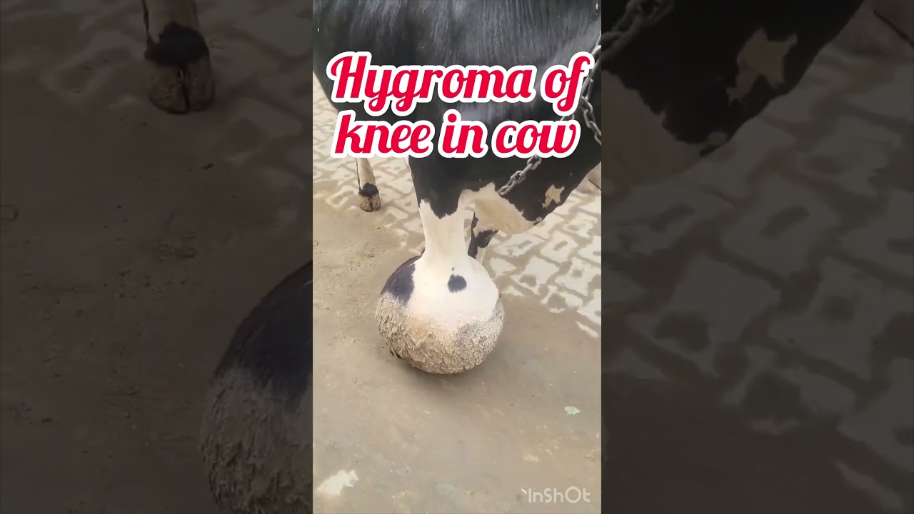 Hygroma of knee l Dr Umar Khan