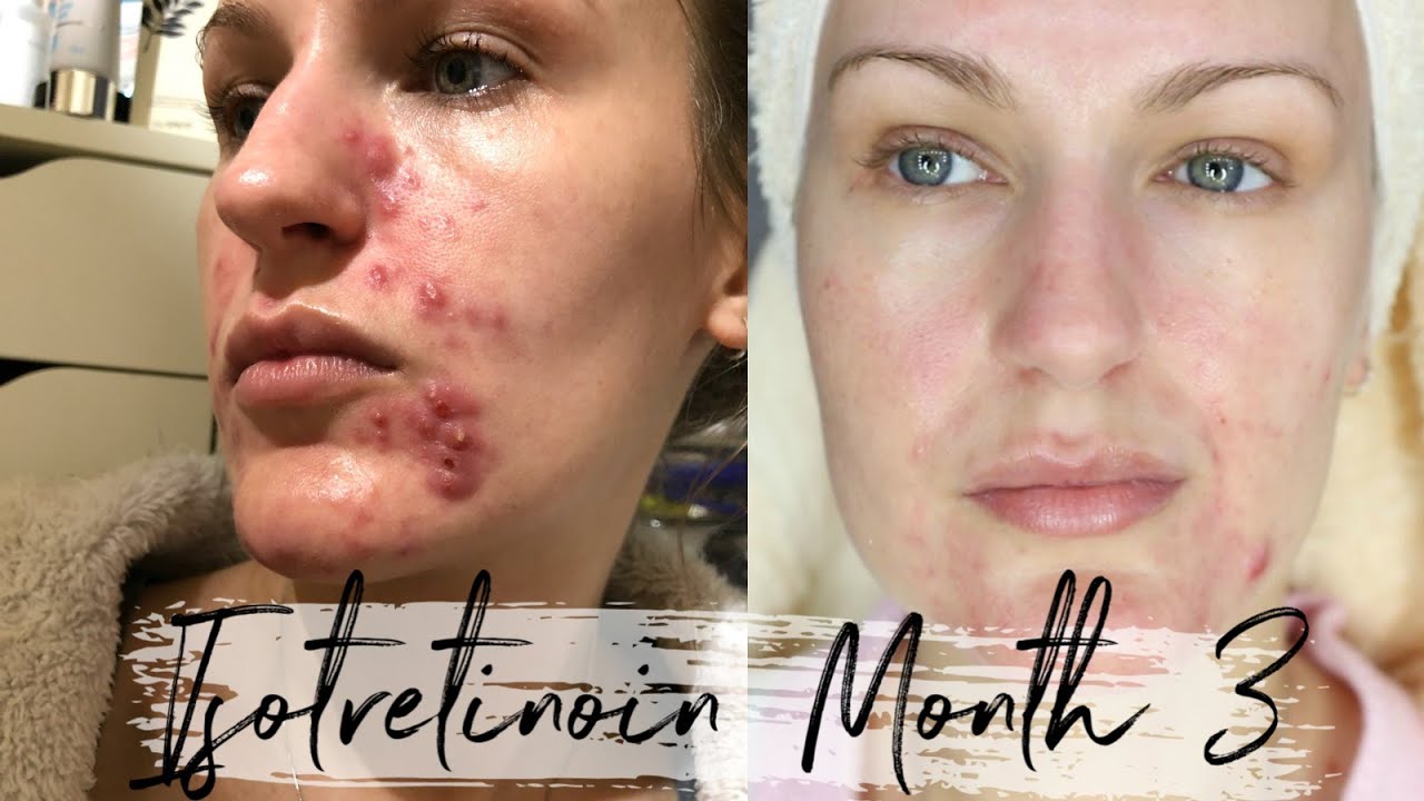 Isotretinoin Diaries -  Month 3 | This is the spot that never ends.