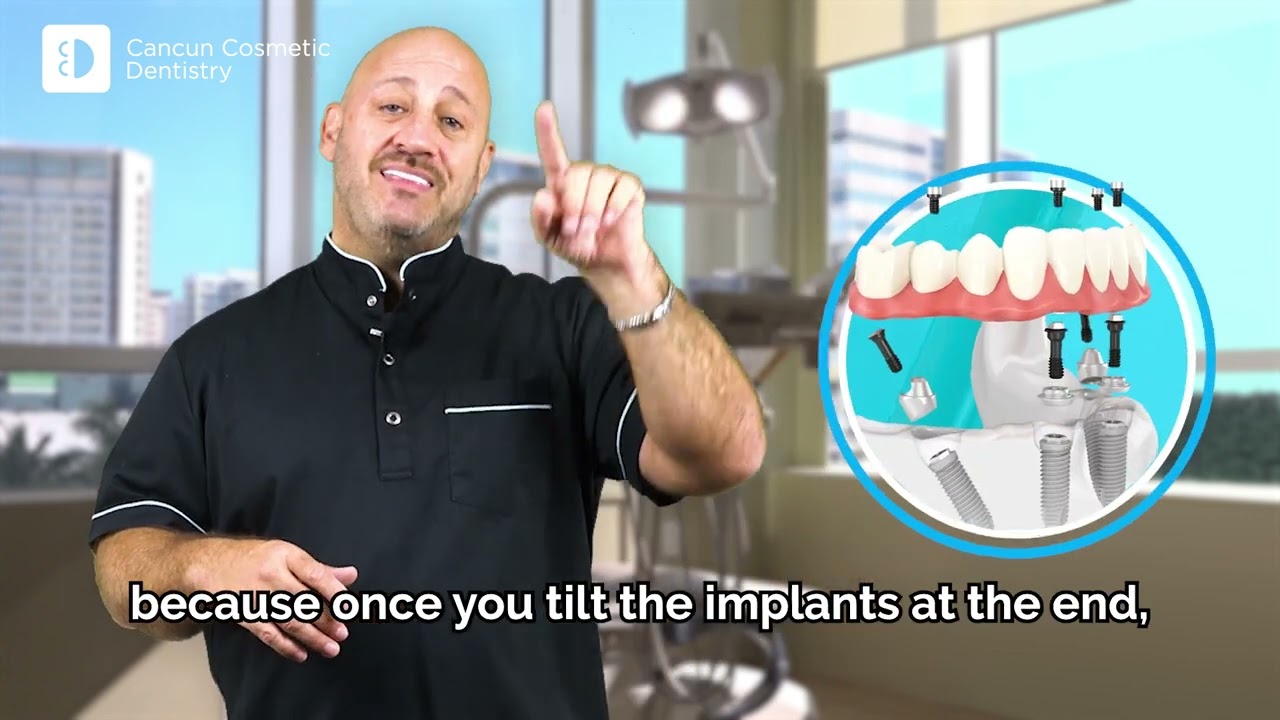 𝐀𝐥𝐥-𝐨𝐧-𝟒  vs 𝐀𝐥𝐥-𝐨𝐧-𝟲  Dental Implants: What You Need to Know | Choosing the Best Implant Solution