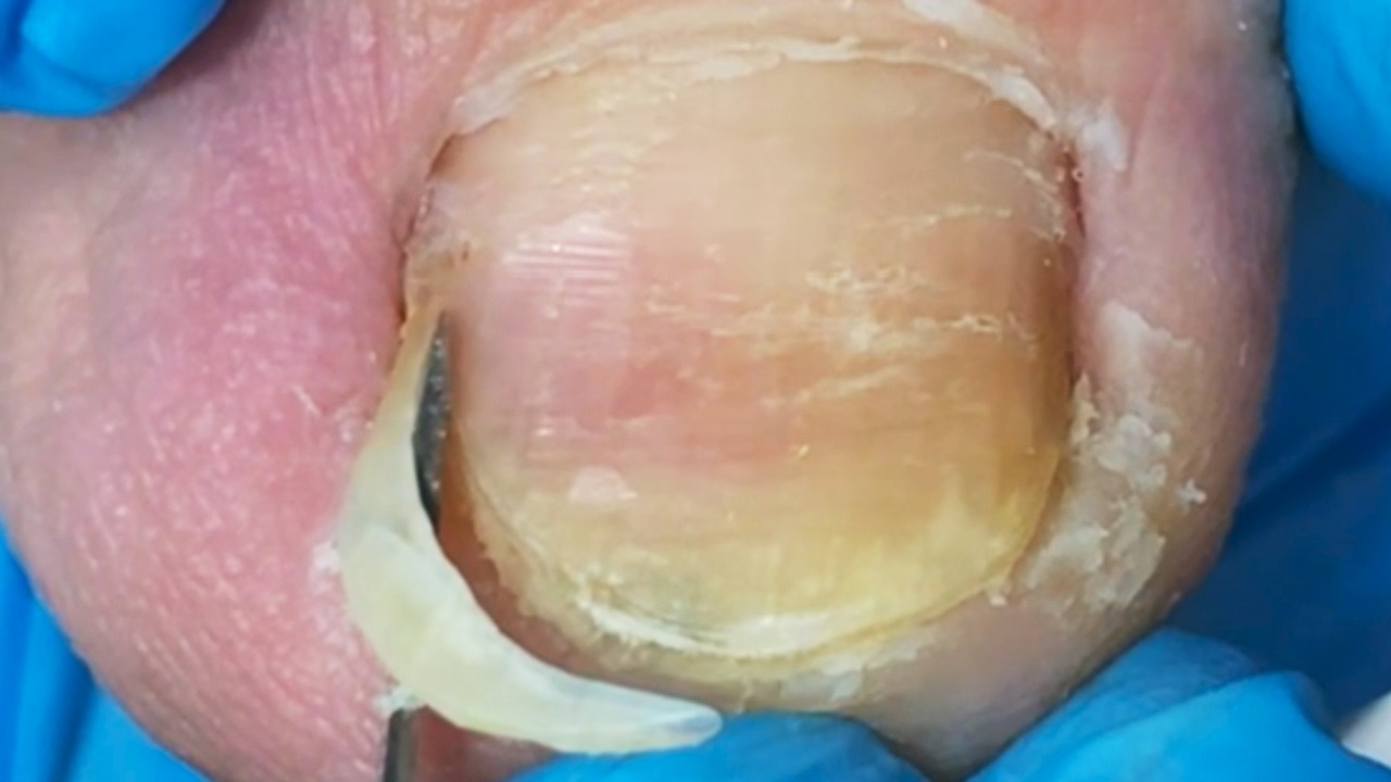The Tip Of The Nail Is Eroded By Fungus, Requiring Careful Trimming【Crazy pedicure room】