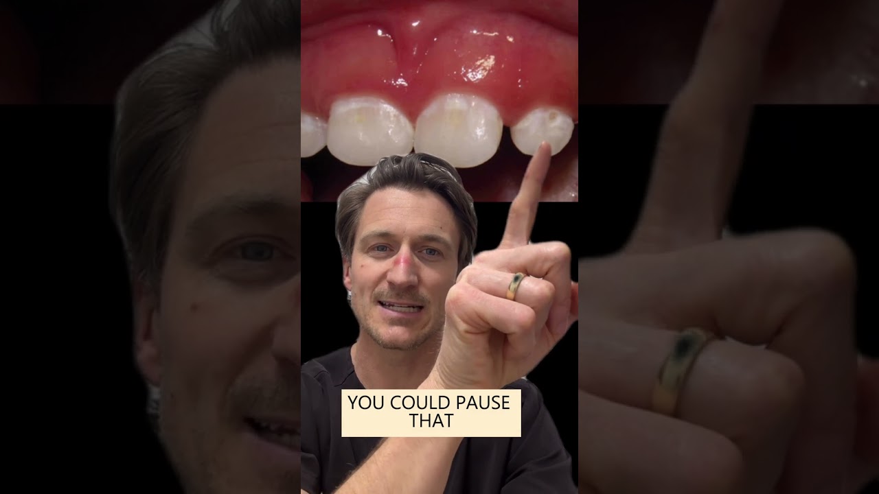 How to Reverse Early Cavities