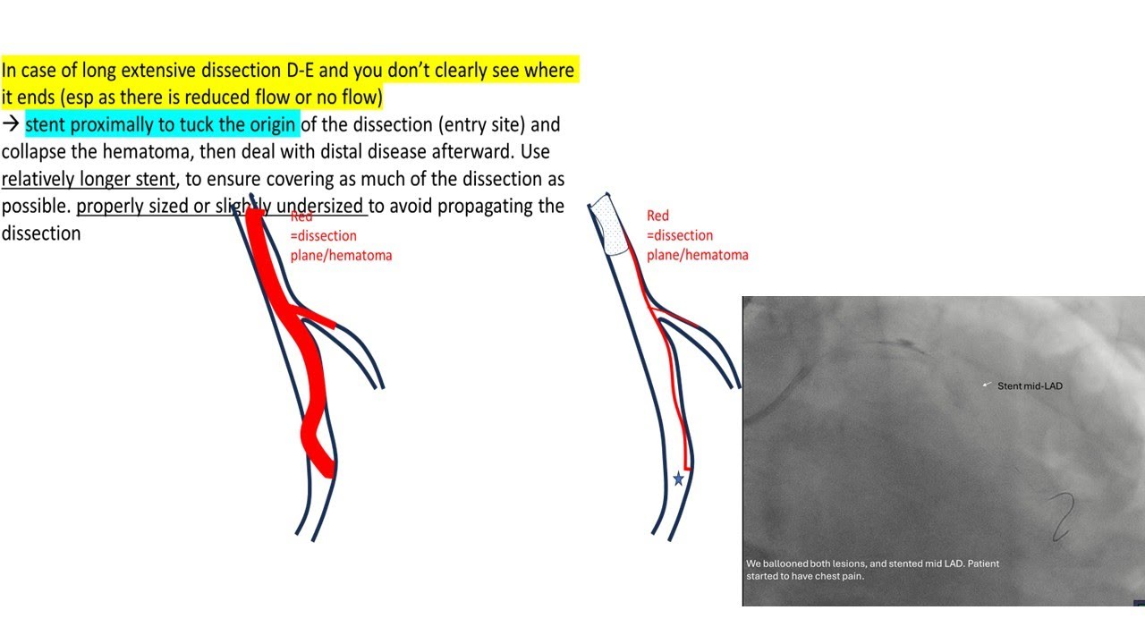 Coronary dissections: cases, types, treatment tips