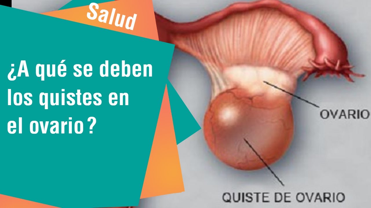 ¿A qué se deben los quistes en el ovario? | Salud
