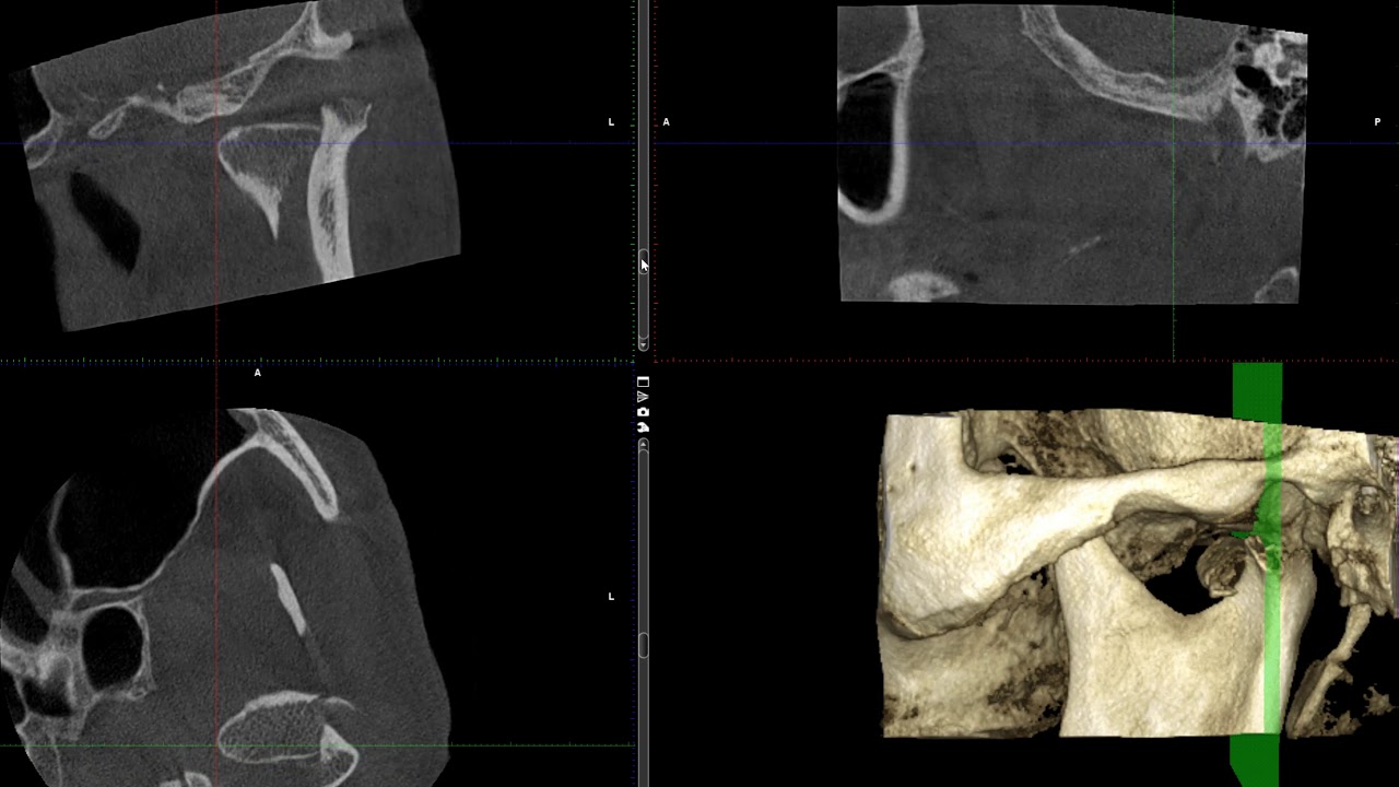 Condyle and condylar neck fracture on CBCT