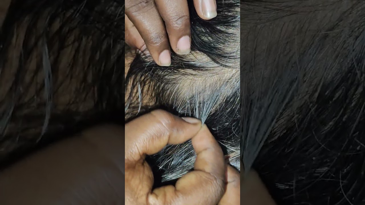 #ASMR GIRL chaking a old lady scalp.ther are lots of lice.and nits