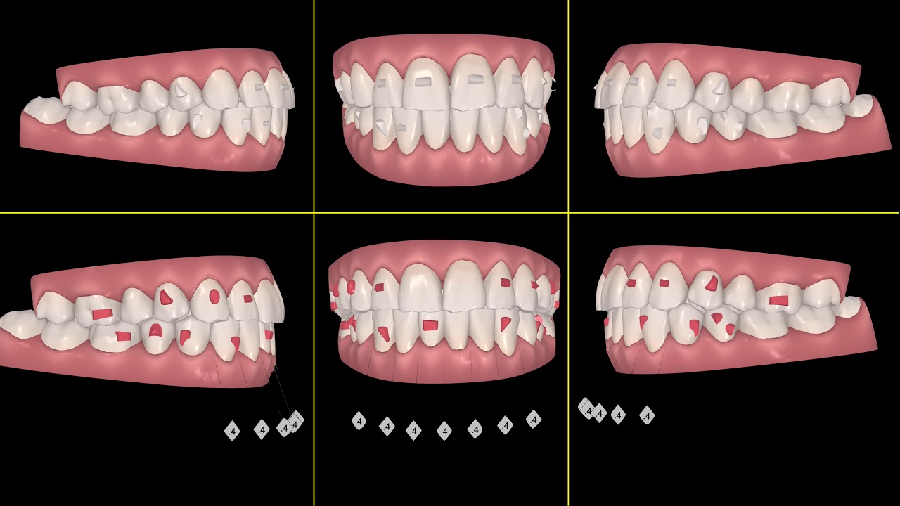 INVISALIGN. Design the perfect clincheck and sequence of movements