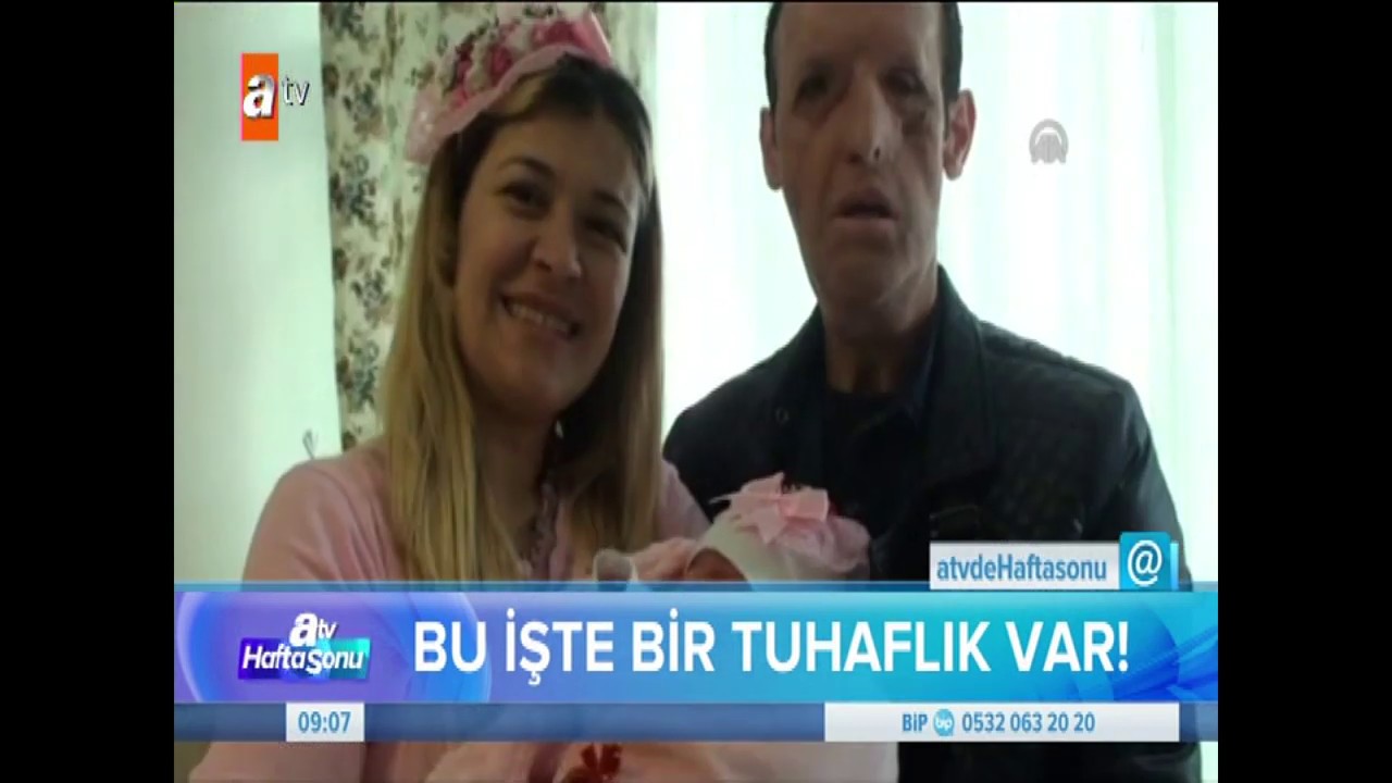 Yüz naklinden sonra ortaya çıkan saldırganlık tesadüf mü psikolojik mi?