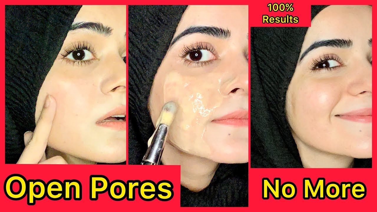 How To Get Rid Of Open Pores On Face | 100% Results Guaranteed | Dietitian Aqsa