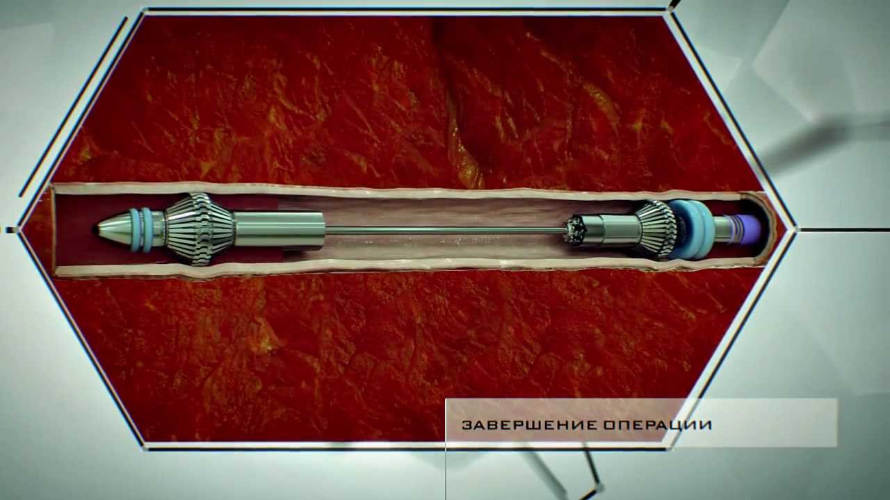 Dahir Insaat: Cholesterol Removal Machine (in Russian) - Full
