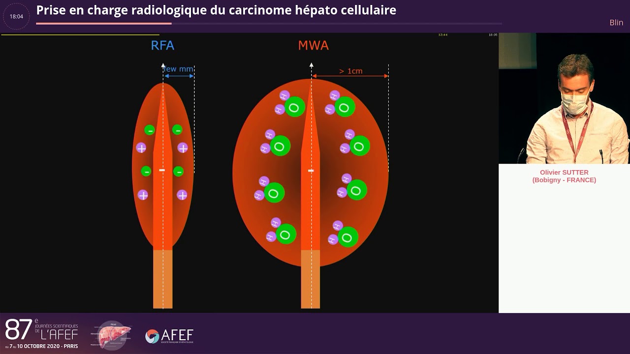 Prise en charge radiologique du carcinome hépato cellulaire - O Sutter