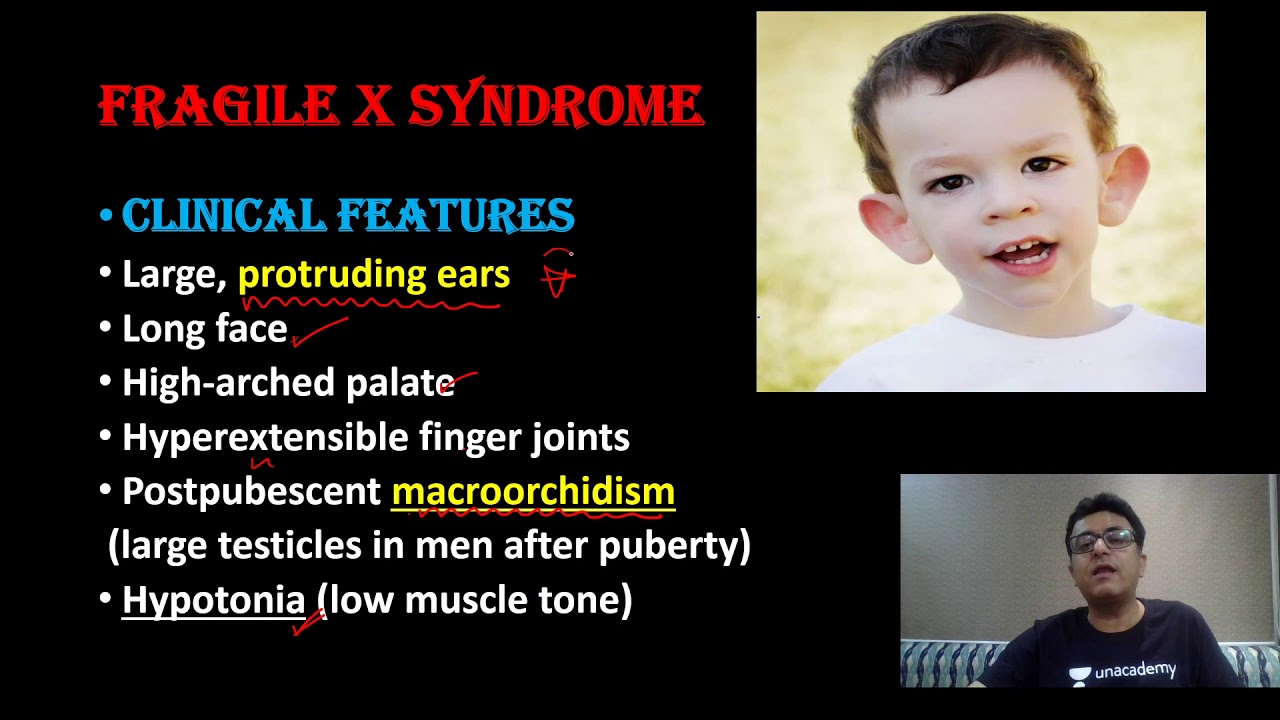 Syndromes | Pediatric Syndromes Part III | Dr. Sanjay Khatri