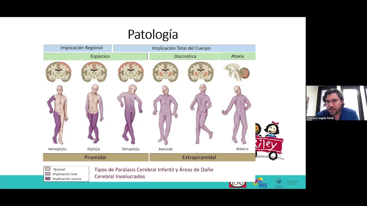 Rehabilitación en parálisis cerebral infantil (PCI)