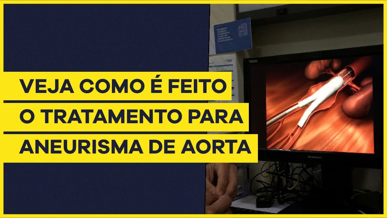 Como é feito o tratamento de aneurisma de aorta