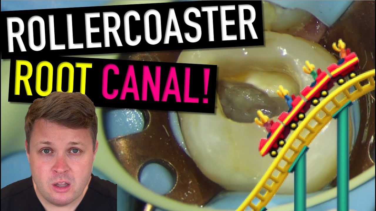 The MB Root Canal Rollercoaster: Curves, Ledges & GP Chaos