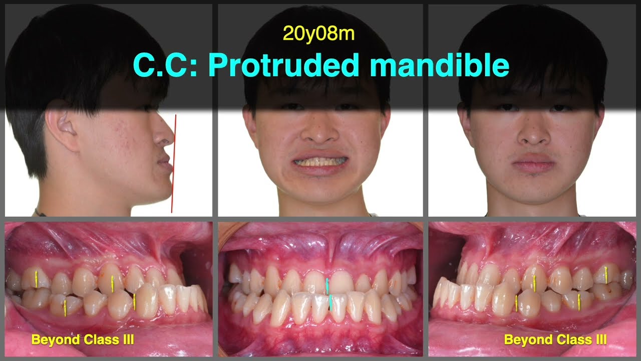 Non-surgical treatment of skeletal Class III malocclusion |【Chris Chang Ortho】CC847