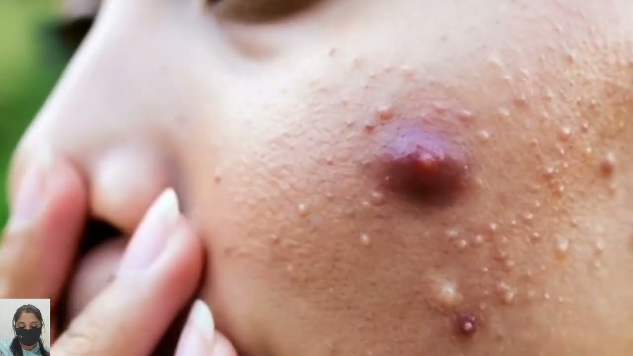 Most Satisfying Pimple Popping Compilation Ever 😍 | Acne Removal 2025&rdquo;