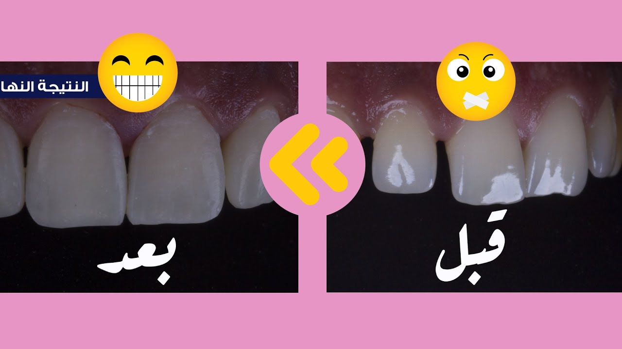 من أعمالنا .. غلق الفراغات بين الاسنان  بالحشوات التجميلية