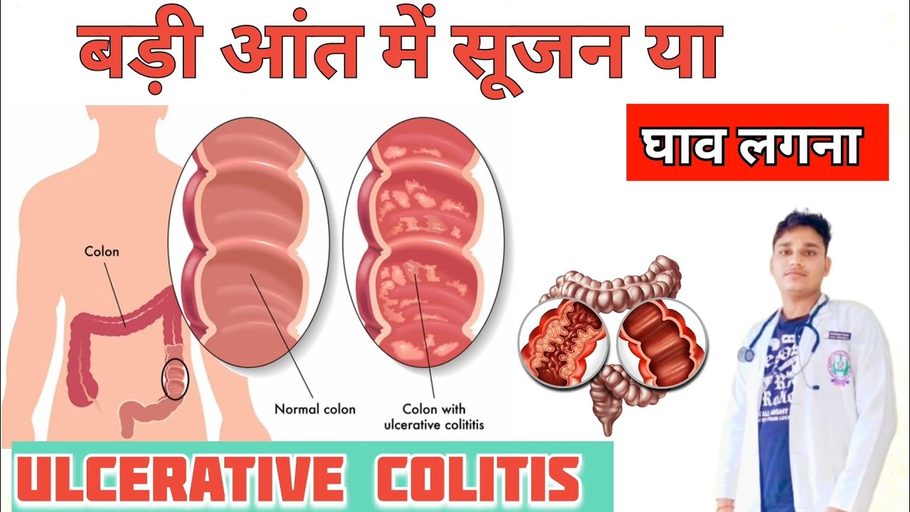 आंत में सूजन या घाव होना | Ulcerative ulcer | ulcerative colitis symptoms, 