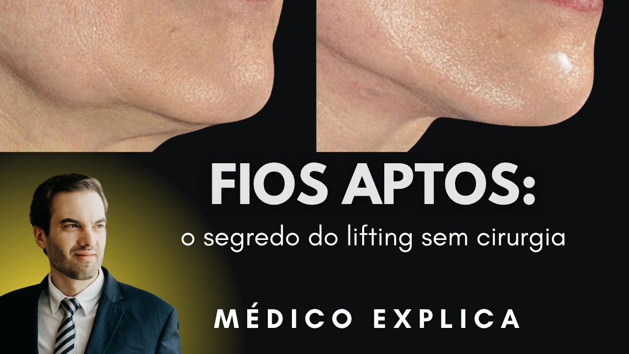 Fios Aptos: o segredo do lifting sem cirurgia