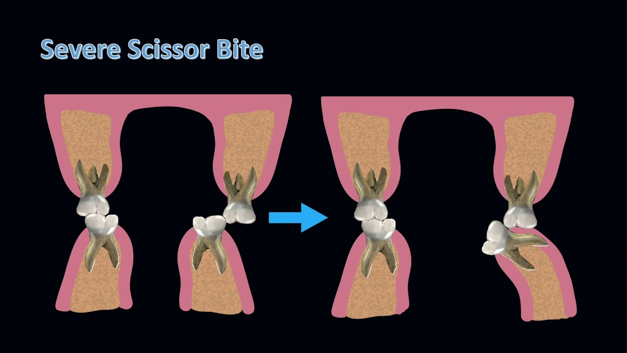 Correcting severe scissor bite in an adult