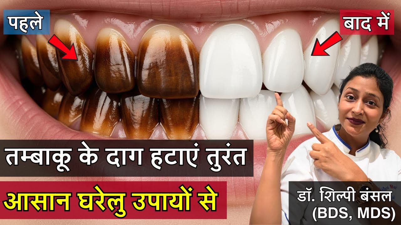 Teeth stain removal home remedy 🦷| Instant Teeth Whitening at Home