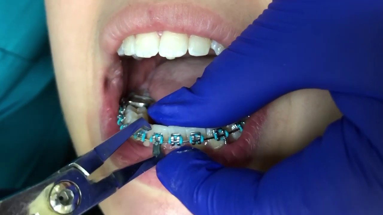 Tooth Time New Braunfels: BRACES OFF!