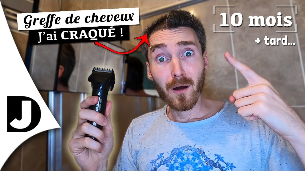 [10 mois post-greffe] Je me rase le crâne ENTIÈREMENT ! 😱