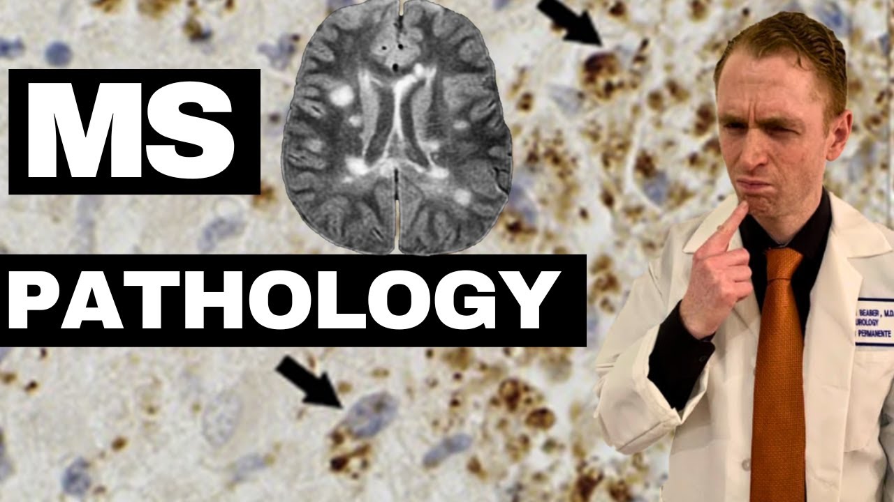 Multiple Sclerosis Pathology