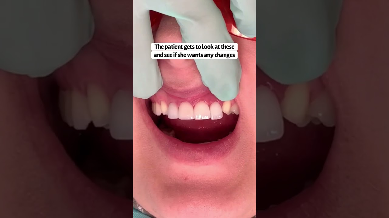 Peg lateral restoration | porcelain crowns front teeth | porcelain veneers front teeth | Dr. Yazdan