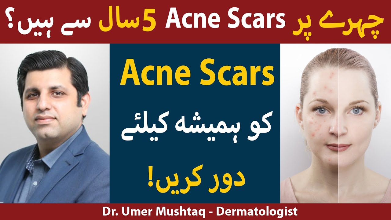Treatments for ACNE SCARS  Kaise Hataye | Acne Scars Removal | How To Remove Acne Scars