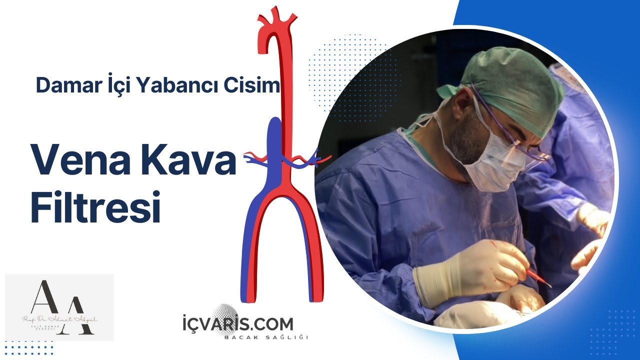 Vena Kava Filtresi Kalıcı Olursa Ne Olur? Riskler ve Önemli Uyarılar – Prof. Dr. Ahmet Akgül
