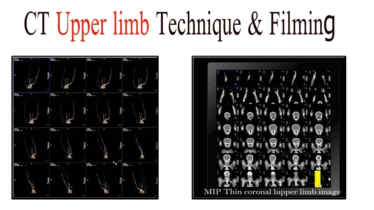 CT angiogram of both upper limb technique and filming