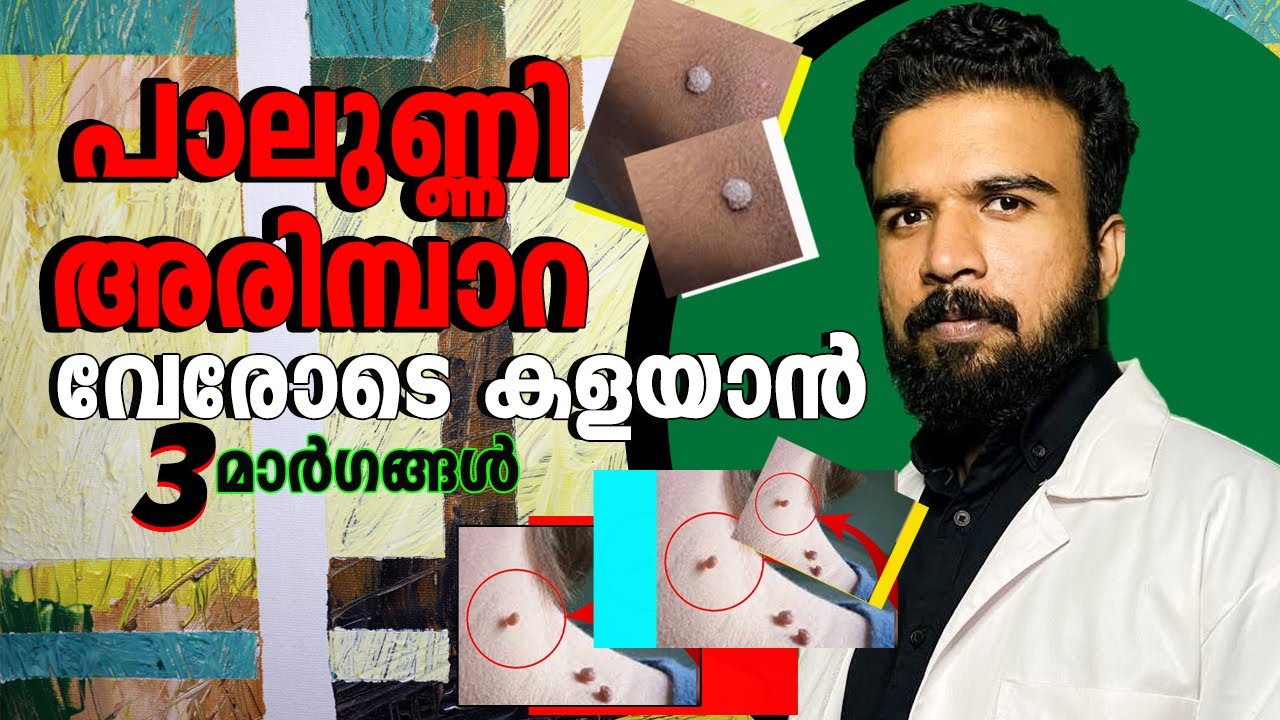 പാലുണ്ണി അരിമ്പാറ വേരോടെ  കളയാൻ ഇവ ചെയ്യുക | How to get rid of warts #warts #healthtipsmalayalam