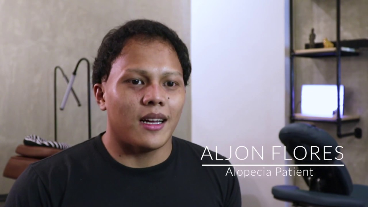 Aljon’s Scalp Micropigmentation (SMP) Story