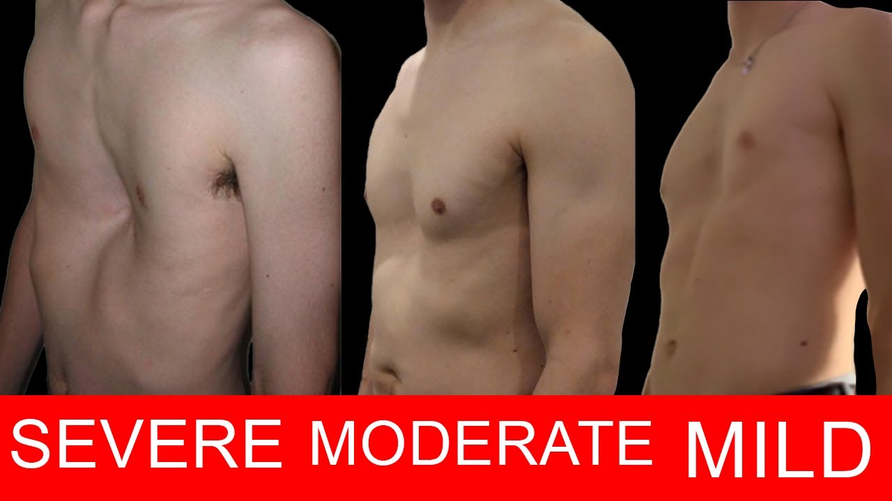 How Severe is Your Pectus Excavatum? (DO THIS TEST)