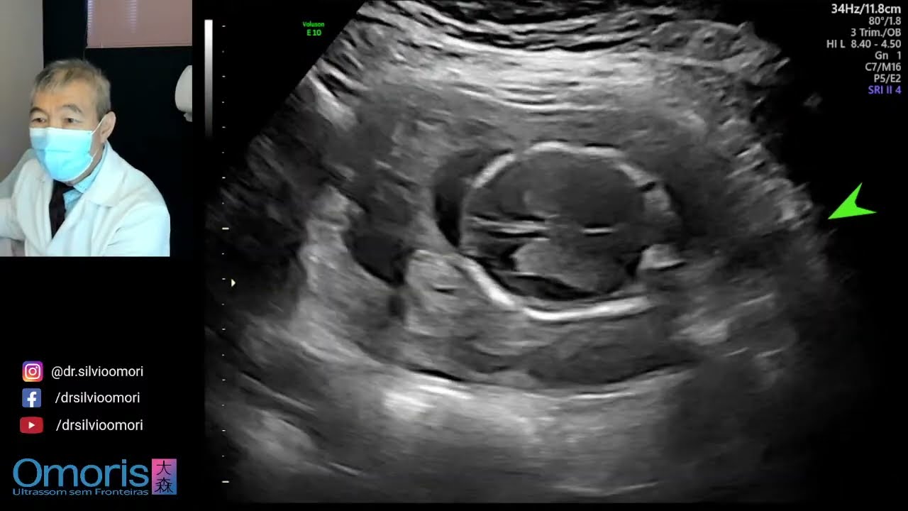 Ultrassonografia 16 semanas!
