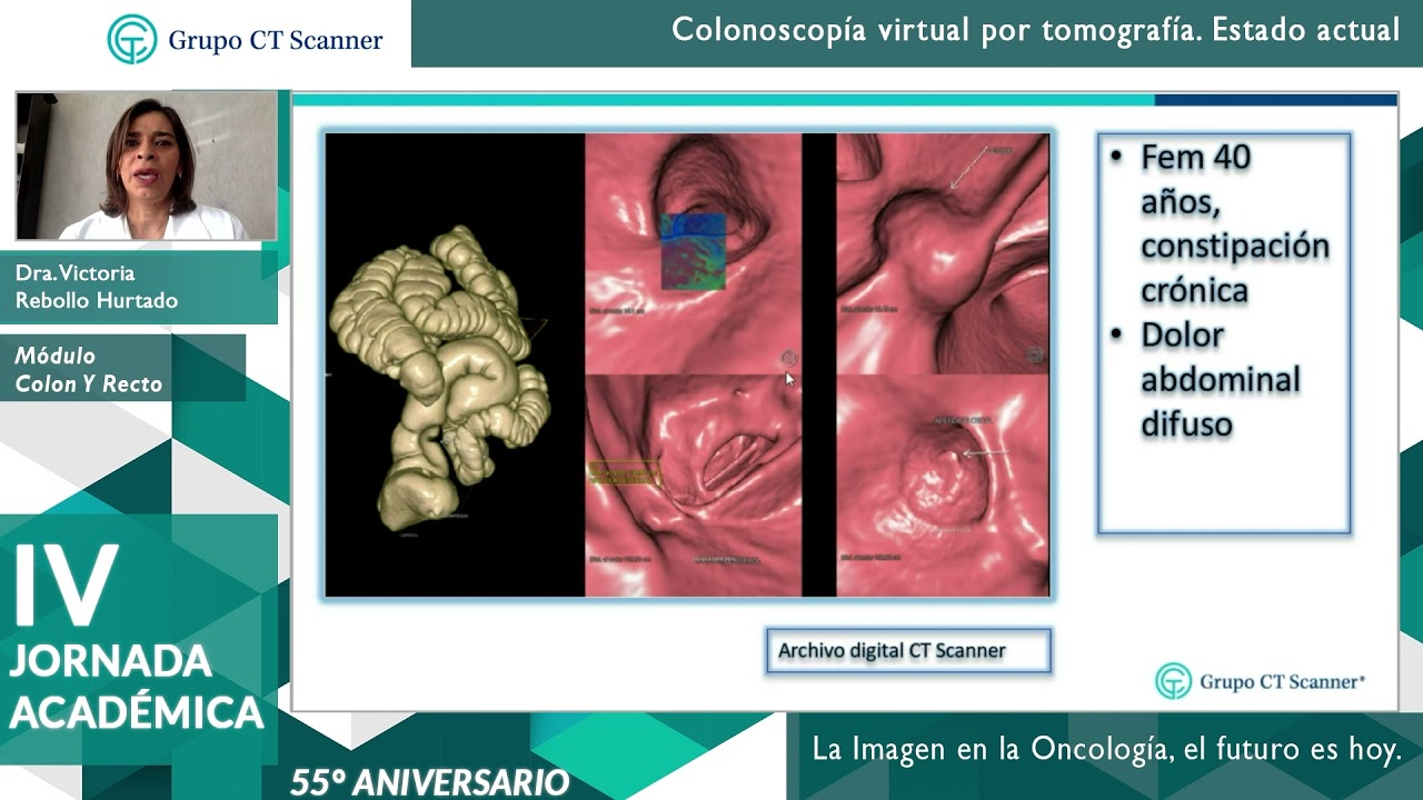 Colonoscopia virtual por tomografía. Estado actual
