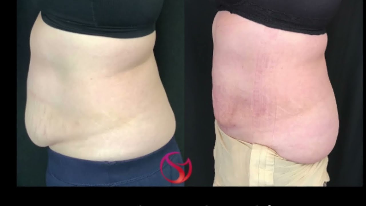 Testimonial Vaser Liposuction and Bodytite with Dr. Shalini Gupta