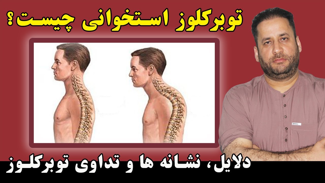 توبرکلوز چیست | توبرکلوز استخوانی چیست | عوامل و نشانه های توبرکلوز چیست | Symptoms of Osteoporosis