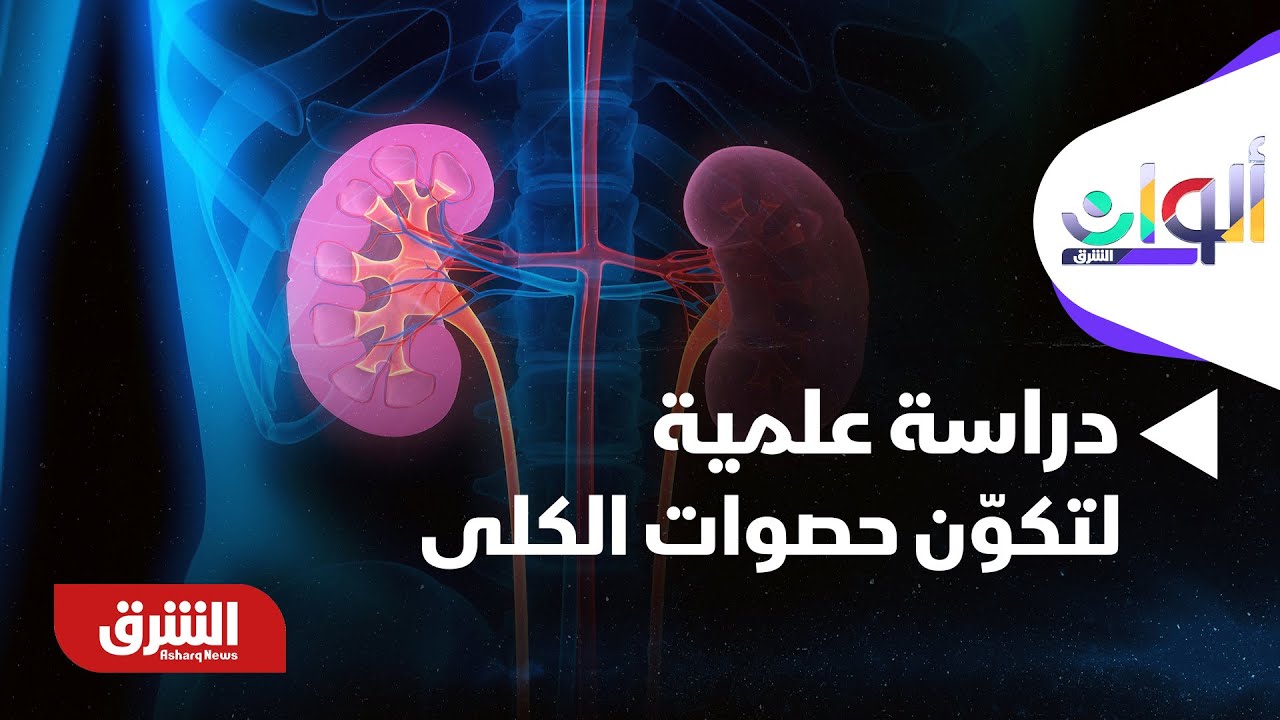 ألوان الشرق - دراسة علمية تكشف سببا غير متوقع لتكوّن حصوات الكلى.. وعلاجات جديدة تقلل تكرار الإصابة