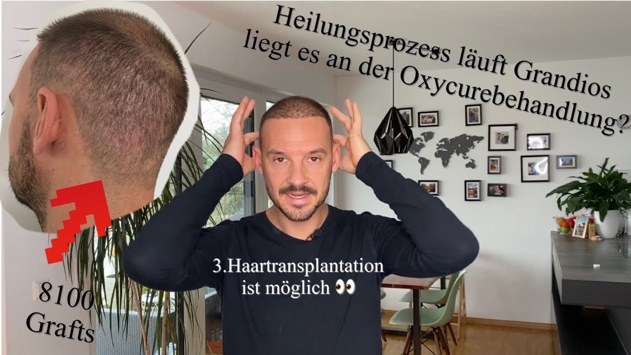 4 Wochen nach der Haartransplantation in Istanbul / Super Heilungsverlauf dank Oxycure
