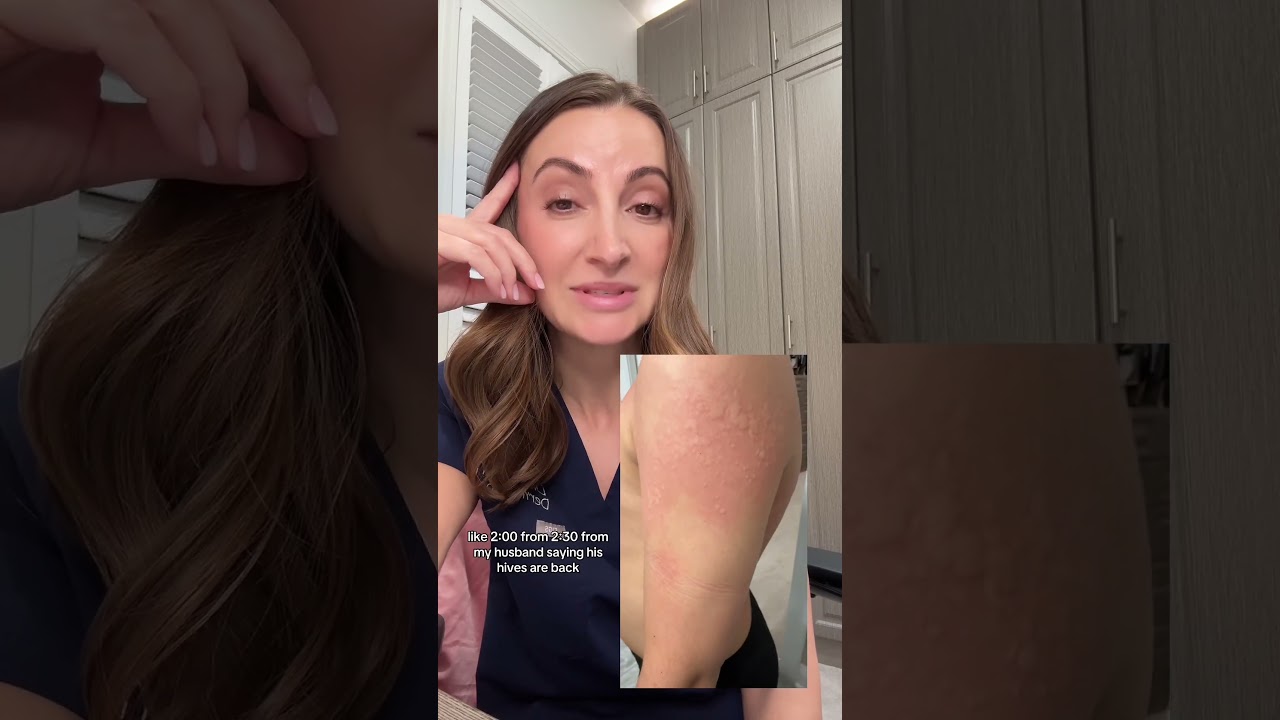 My Child&rsquo;s First Hives! 😱 What I Did as a Dermatologist Mom