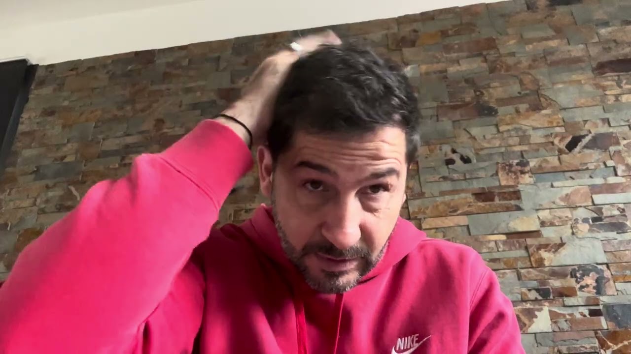 9 mois après la greffe de cheveux à la clinique COSMEDICA à Istanbul 