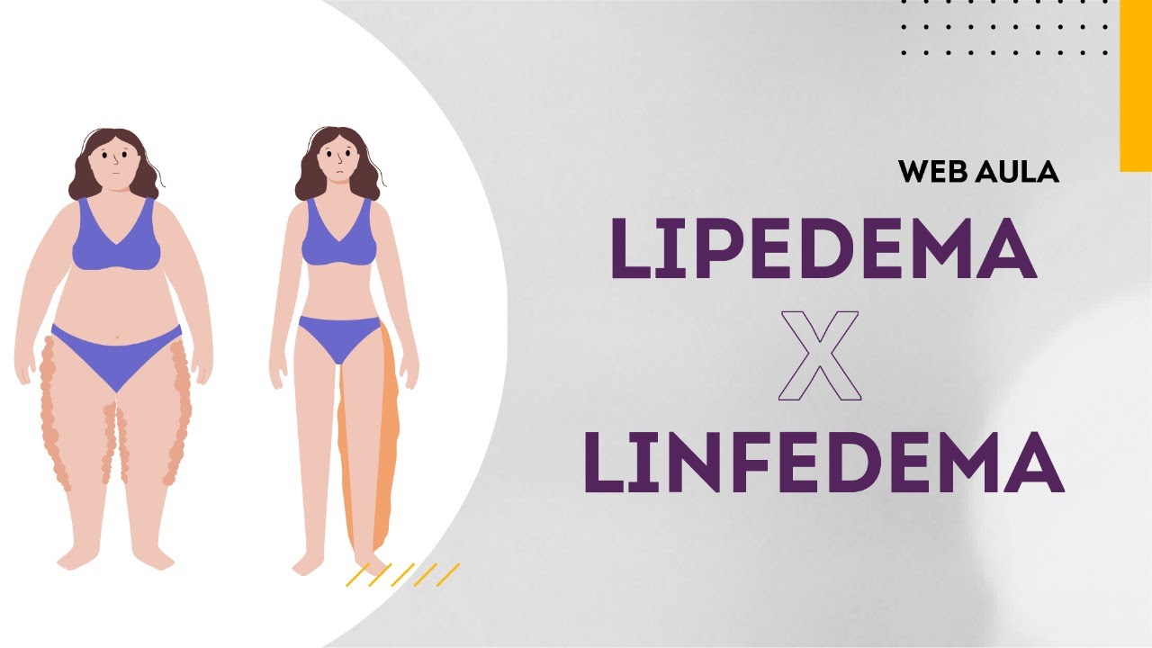 Entenda as diferenças entre lipedema e linfedema | Web Aula gratuita #120